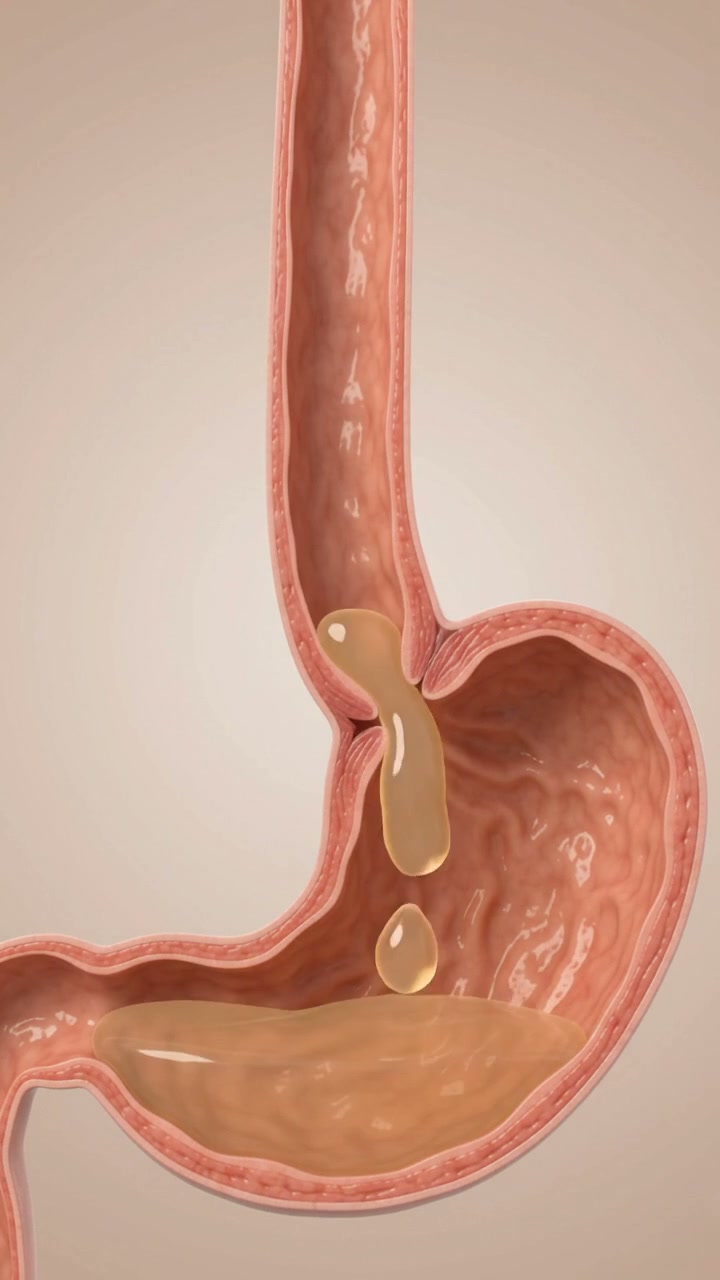 Illustrative reflux at the junction between the esophagus and stomach. Fluid colour and movement are simplified.
